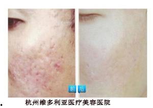 激光痘印视频,科技助力美丽肌肤的秘密武器